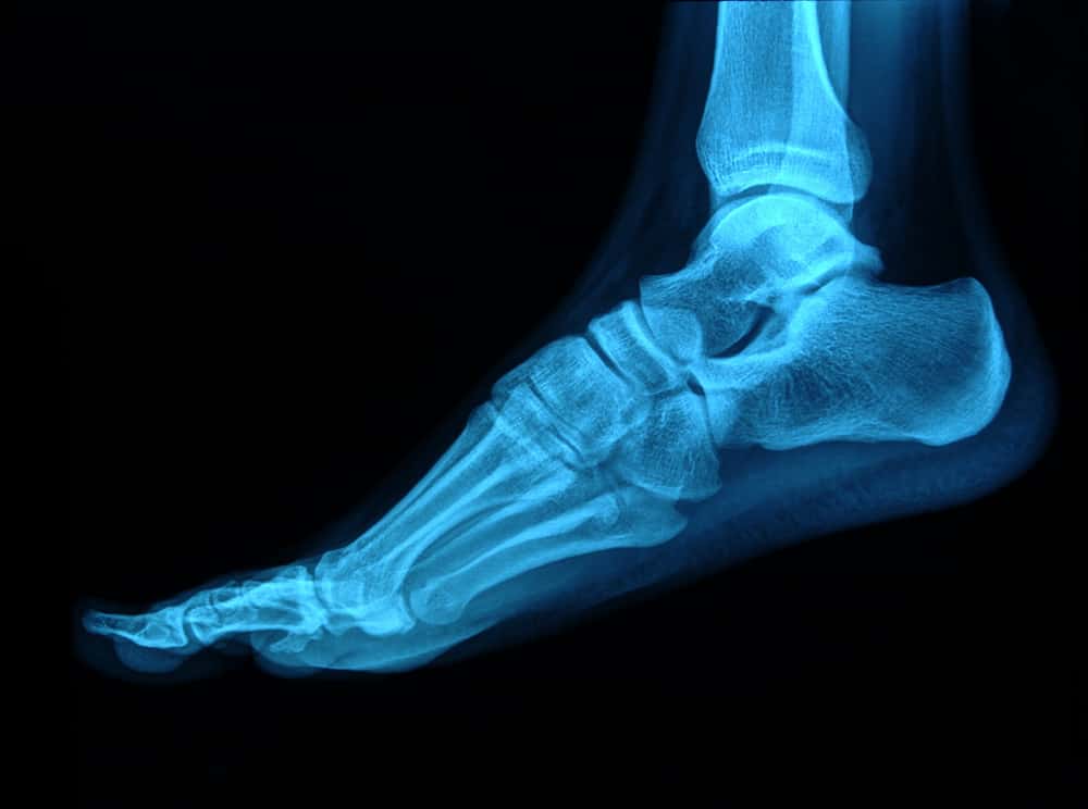 X-ray of a foot including ankle bone