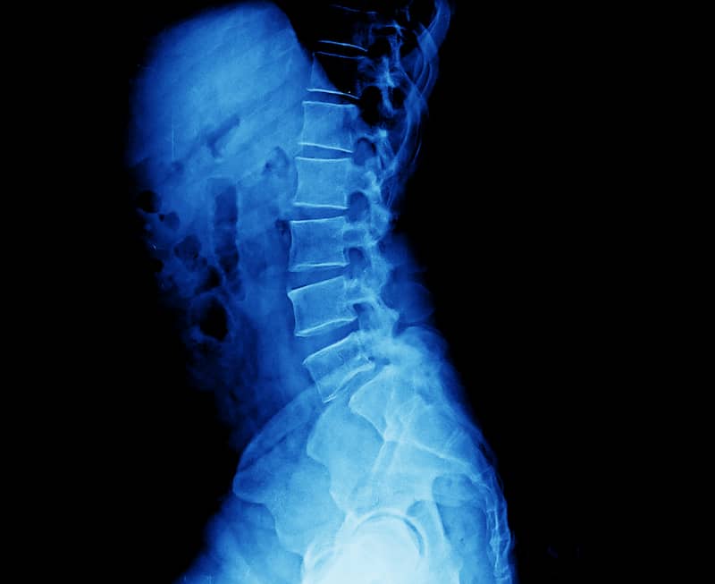 X-ray of a human neck (bones).